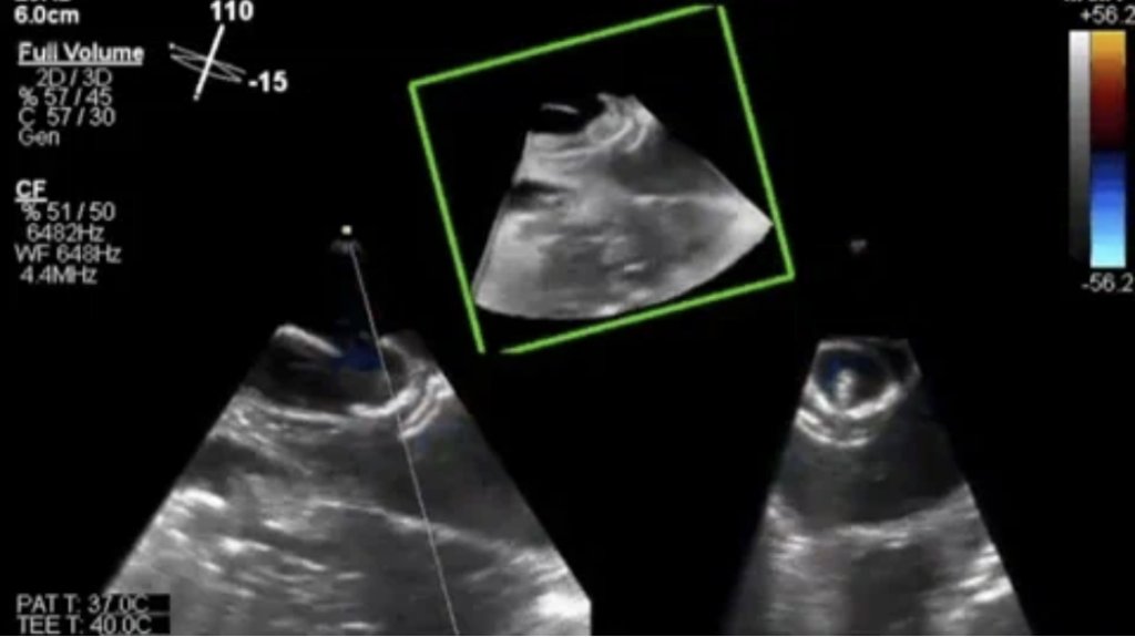 Transesophageal echocardiography showing successful occlusion of a patent ductus arteriosus, a common congenital heart disease in dogs.  Color flow doppler echocardiography showing severe mitral valve insufficiency and left heart enlargement in a dog with degenerative mitral valve disease. Mitral valve disease is the 