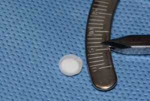 6mm diameter non-dissolvable cyclosporine implant